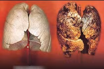 Điểm mặt những bộ phận cơ thể dễ bị ung thư nhất