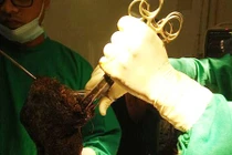 Choáng váng trước bà mẹ trẻ đau dạ dày vì…nuốt búi tóc “khủng”