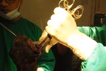 Choáng váng trước bà mẹ trẻ đau dạ dày vì…nuốt búi tóc “khủng”