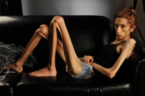 Hình ảnh khủng khiếp cô gái cao 1m70, nặng 22kg