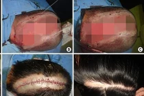 Kinh hoàng cô gái Hàn bị tróc da đầu chỉ vì nhuộm tóc