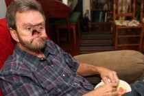 Mũi biến dạng vì căn bệnh ung thư quái ác