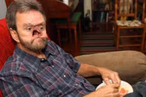 Mũi biến dạng vì căn bệnh ung thư quái ác