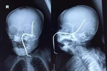 Hà Nội: Tai nạn hi hữu, bé gái 8 tháng bị thanh sắt rỉ xuyên hộp sọ