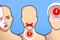 Dấu hiệu cảnh báo cơn đột quỵ “hỏi thăm” bạn