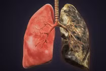 Những ai dễ bị ung thư phổi như nhà thơ Nguyễn Trọng Tạo?