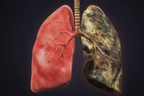 Những ai dễ bị ung thư phổi như nhà thơ Nguyễn Trọng Tạo?