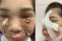 Cô gái xinh đẹp biến dạng vì rạch mặt nặn mủ sau tiêm mỡ tự thân làm đẹp