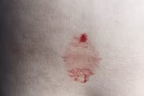 TP HCM phát hiện một trường hợp bị “mồ hôi máu” 