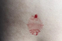 TP HCM phát hiện một trường hợp bị “mồ hôi máu” 