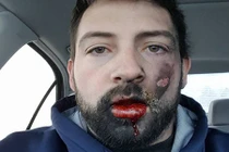 Kinh hãi thuốc lá điện tử nổ tung trong miệng