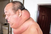 Khổ sở cổ to bằng vai vì chữa bệnh sai cách