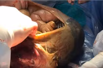 Kỳ tích mang thai ngoài tử cung vẫn sinh con khỏe mạnh