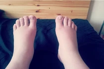 Làm thế nào để chân đỡ bị phù nề khi mang thai?