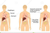Bệnh trào ngược thực quản có thể dẫn đến ung thư