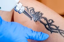 Sự thật phũ phàng cần biết trước khi quyết định xóa xăm