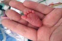 Bé sơ sinh nhỏ nhất thế giới chỉ nặng bằng quả ớt chuông