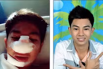 Nam người mẫu tiêu tan sự nghiệp vì nâng mũi giá rẻ