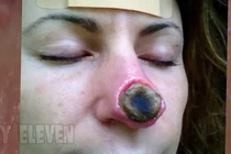 Quý bà bị mất mũi vì tự bôi thuốc chữa ung thư