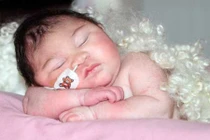 Thương tâm bé thoát vị não không thể khóc và mở mắt