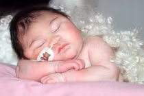 Thương tâm bé thoát vị não không thể khóc và mở mắt