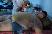 Cậu bé 11 tuổi nặng 146kg dùng lửa đốt mỡ bụng