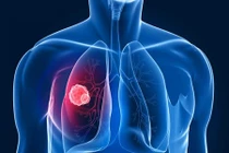 Nguyên nhân gây ung thư phổi kể cả không hút thuốc lá