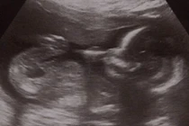 Hy hữu bà mẹ mang thai cả trong và ngoài tử cung