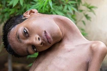 Cái kết buồn lòng của cậu bé có đầu nghiêng 180 độ