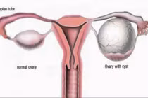 Cách nhận biết u nang buồng trứng đơn giản không ngờ