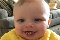 Em bé bị nghẹt thở 100 lần/ngày vì lưỡi quá khổ