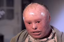 Kỳ tích sống sót của người phụ nữ mắc bệnh da rắn 