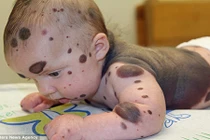 Bé 4 tuổi phẫu thuật 26 lần vì nốt ruồi khắp người