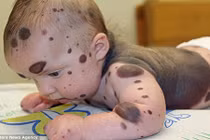 Bé 4 tuổi phẫu thuật 26 lần vì nốt ruồi khắp người