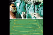 Hãi: Bác sĩ kéo sán dây 1,8 m ra khỏi miệng bệnh nhân