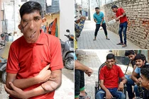 Khối u đáng sợ biến khuôn mặt trai trẻ thành mặt voi