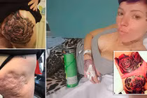 Bà mẹ trút bỏ mặc cảm bằng cách xăm đè lên sẹo áp-xe