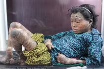 Cô bé người cá may mắn đổi đời nhờ vaseline