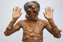 Ông bố bị xem như quái vật mong được cứu thị lực