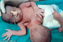 Choáng váng ca sinh đôi ký sinh kỳ lạ nhất thế giới 