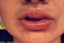 Thiếu nữ bỏng môi độ 3 vì làm trắng răng bừa bãi