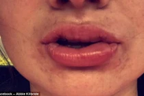 Thiếu nữ bỏng môi độ 3 vì làm trắng răng bừa bãi