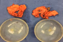 Quý bà suýt chết vì silicon nâng ngực lên nấm mốc