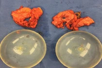 Quý bà suýt chết vì silicon nâng ngực lên nấm mốc