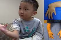 Bé 8 tuổi được ghép ngón chân làm ngón tay