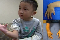Bé 8 tuổi được ghép ngón chân làm ngón tay