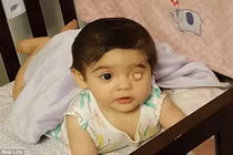 Em bé bẩm sinh một mắt không có nhãn cầu