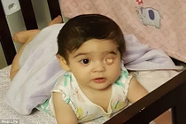 Em bé bẩm sinh một mắt không có nhãn cầu