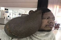 Kinh hãi khối u to gấp đôi sọ người mọc trên đầu