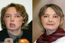 Bệnh nhân đầu tiên cấy ghép mặt đã chết vì ung thư